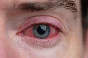 Can Dry Eyes Cause Blindness? What You Need to Know to Protect Your Vision