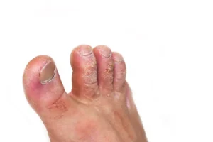 Does Athlete’s Foot Smell? What That Odor Might Be Telling You